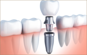 Paradise Hills Dentistry - Dr. Bryan Tran Dental Implant