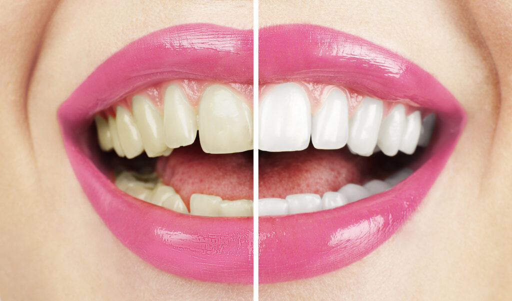 Teeth Whitening Results