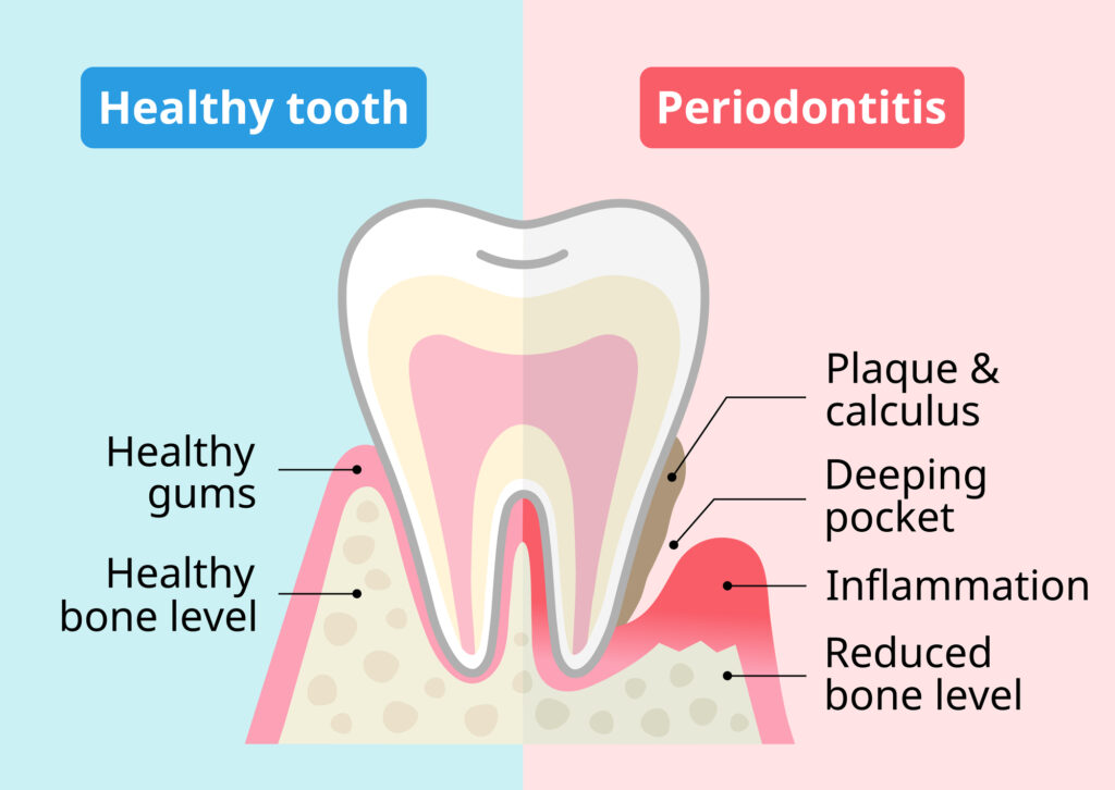 Tooth Decay